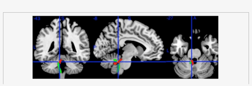 The Left Superior Cerebellar Peduncle And Left Inferior - Inferior Cerebellar Peduncle Dti, transparent png download