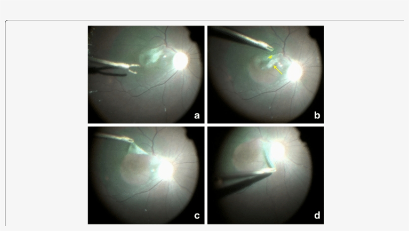 Typical Video Images Of The Surgical Process - Tissue, transparent png download