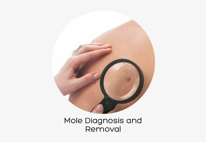 Skin Cancer, transparent png download