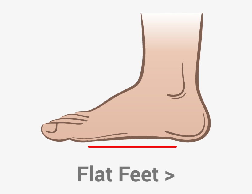 When Your Longitudinal Arch Pronates It Functions Like - Flat Feet, transparent png download