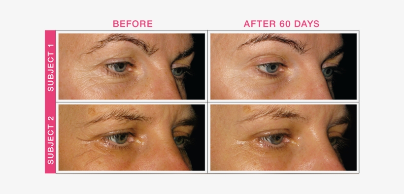 Bottom Line, Subjects Experienced Smoother Skin With - Biosil Effect Before After, transparent png download