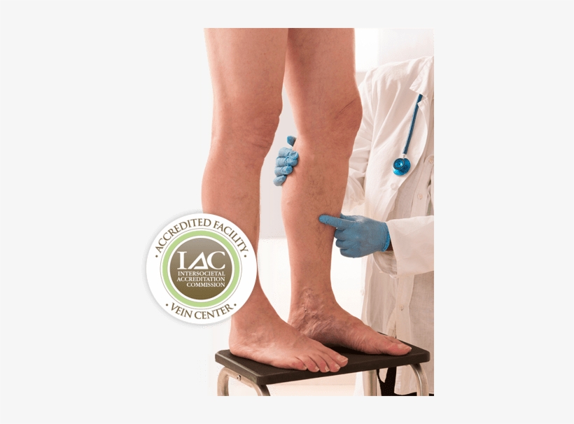 Comprehensive Vein Treatment - Varicose Veins, transparent png download