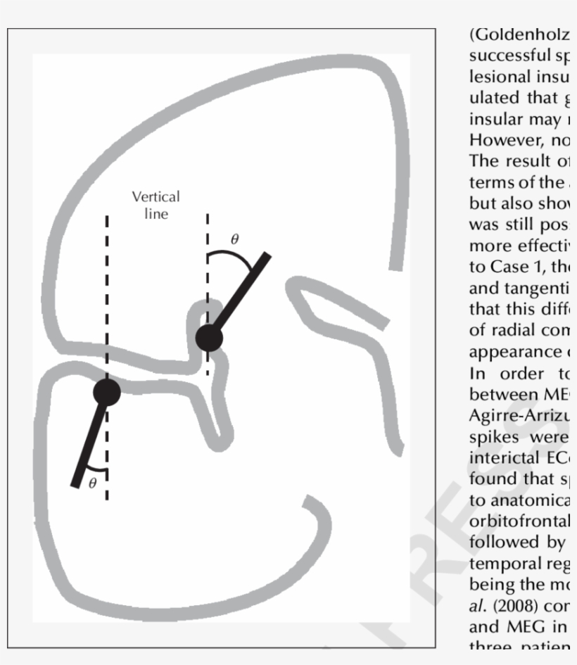 Coronal Schema Showing Angle Between The Spike Dipole - Paper, transparent png download