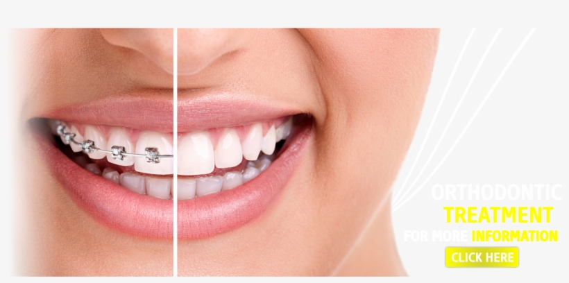 Sevgi Dental Clinic, Dental, Dental Clinic, Dentist, - Braces On Vs Off, transparent png download