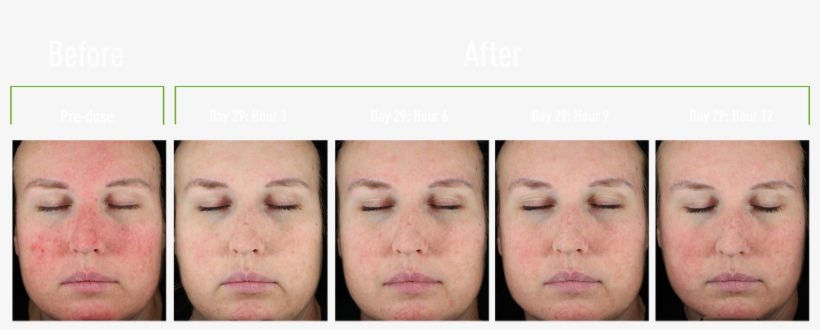 Unretouched Photos Of Clinical Trial Subject - Colorfulness, transparent png download