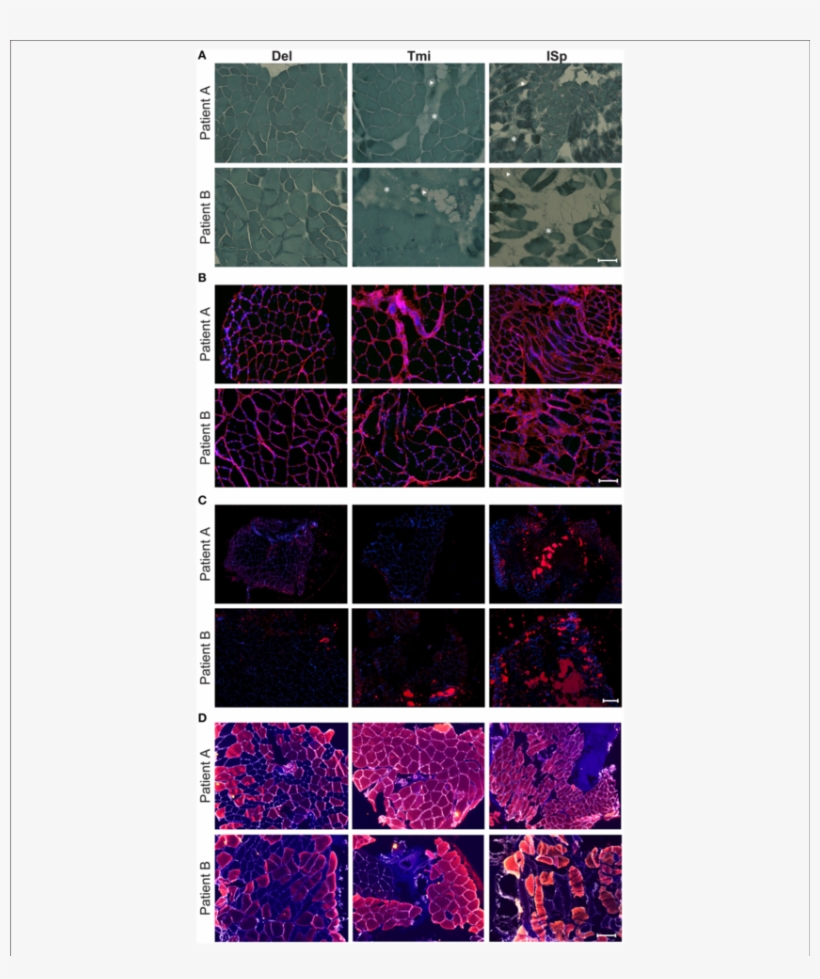 Histological Markers Of Muscle Degeneration In Torn - Muscle, transparent png download