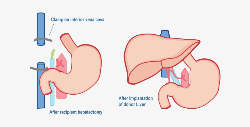 Diseased Donor Liver Transplantation - Wockhardt Hospitals, transparent png download