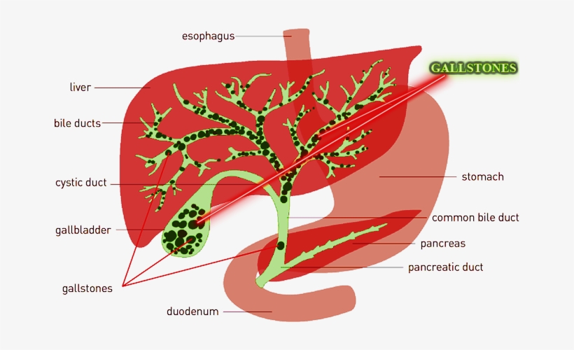 Http - //www - Tiptophomeremedies - Com/wp Gallstones - Liver Gallbladder Cleanse, transparent png download