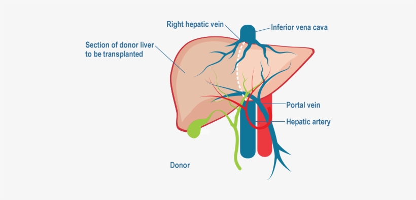 Live Donor Liver Transplantation - Liver Transplantation, transparent png download