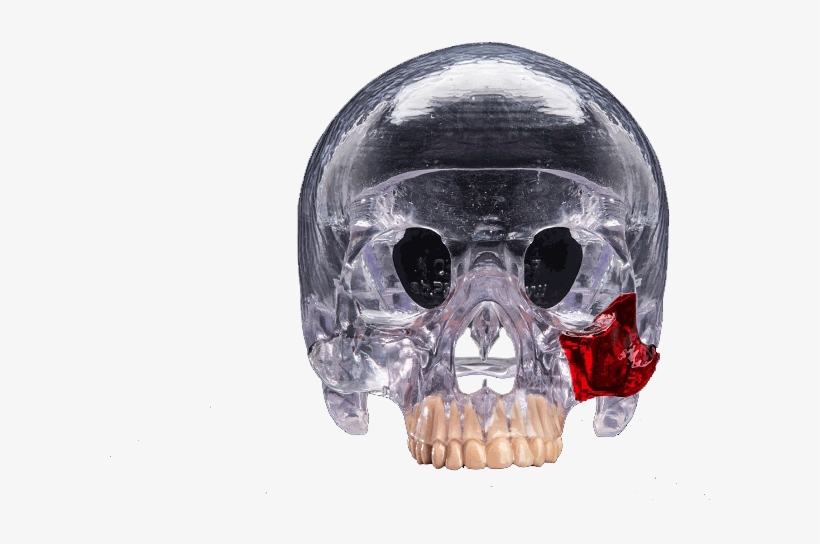 3d Printed Head Skull Transparent Surgical Guide - 3d Printing, transparent png download