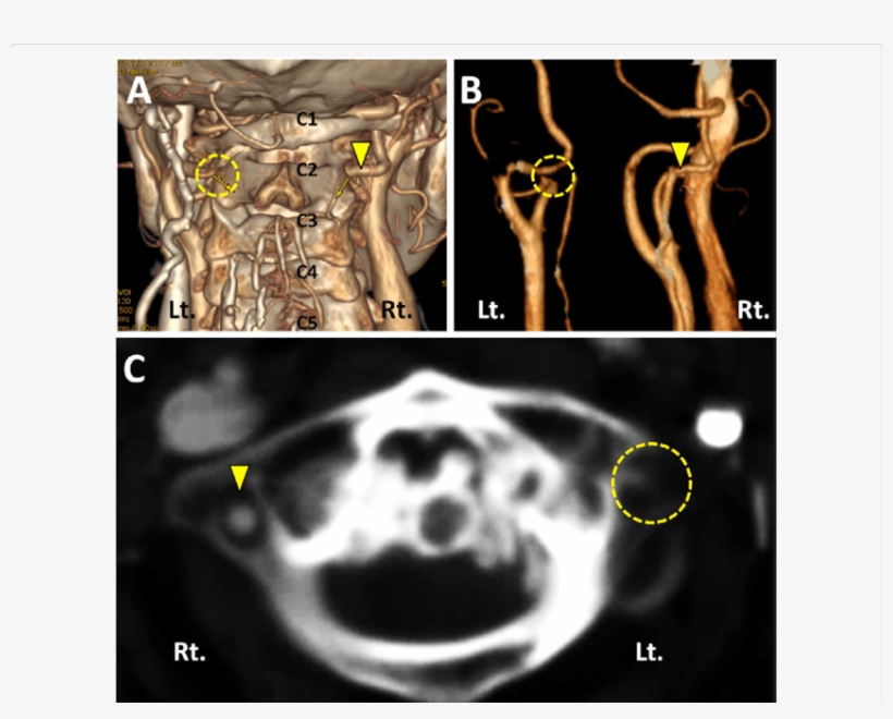 Ra Is Associated With A High Incidence Of Destruction - Radiology, transparent png download