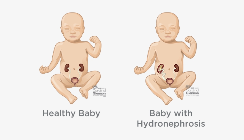 If Your Baby Has Restricted Urine Flow Or Urine Reflux, - Hydronephrosis In Fetus, transparent png download