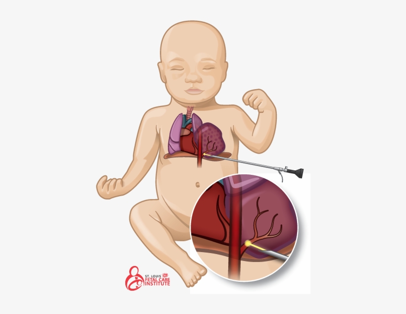 Graphic Of Baby With Bronchopulmonary Sequestration - Bronchopulmonary Sequestration, transparent png download