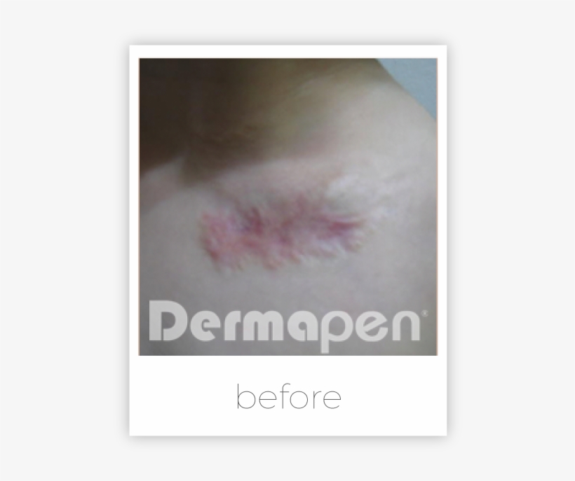 Treat Burn Scars - Harley Cosmetic London, transparent png download