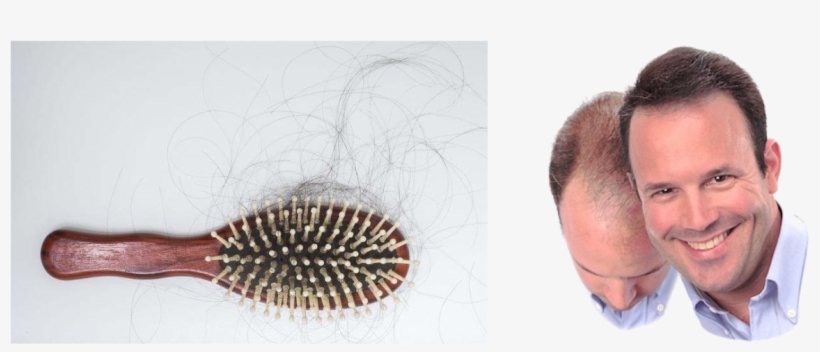 Hair Loss Treatments & Hair Transplant - Dermmatch Hair Loss Concealer Medium Brown, transparent png download