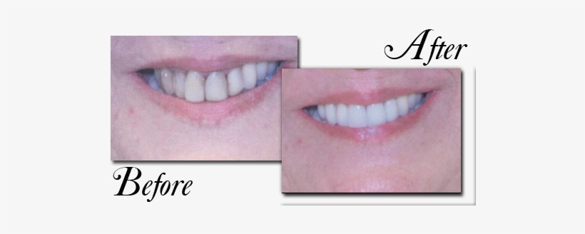 Our Patient Had Existing Old White Fillings In Her - White Fillings Front Teeth, transparent png download