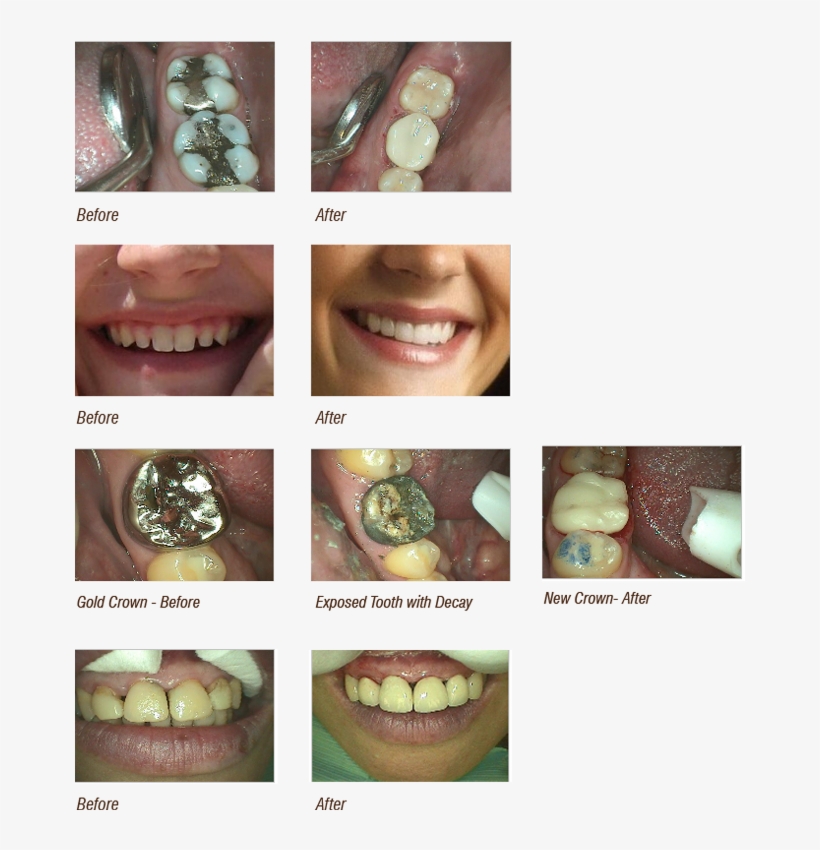 Before And After Cosmetic Dentistry Image - Castle Valley Dental, transparent png download