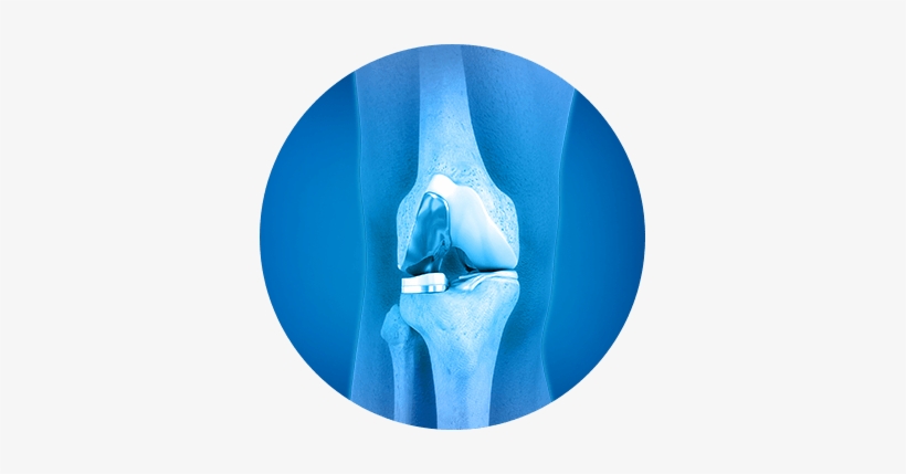 About Partial Knee Joint Replacement - Joint K Nee Png, transparent png download