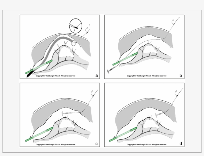 Percutaneous Colonic Anvil Control A, Once The Correct - Large Intestine, transparent png download