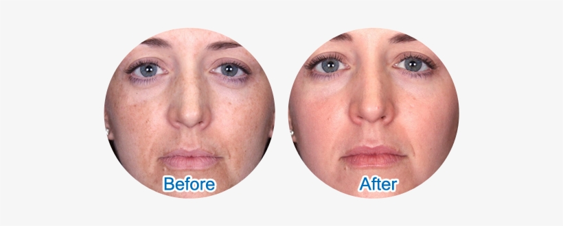 Cells Of Skin & Improve The Skin Texture - Chemical Peel Anti Aging, transparent png download