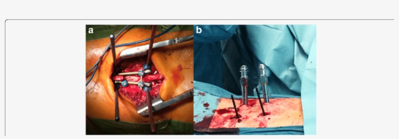 Open Approach For Pedicle Screw Placement And Minimal - Common Fig, transparent png download
