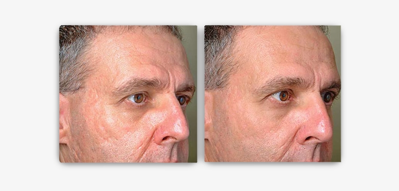 *results May Vary - Profractional Laser Before And After, transparent png download