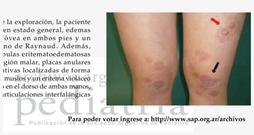 Placas Eritematosas, Violáceas Y Ligeramente Descamativas - Erythema, transparent png download