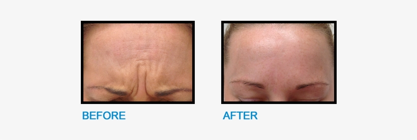 Frown Lines Malahide Before And After Photo - Saravana Stores, transparent png download