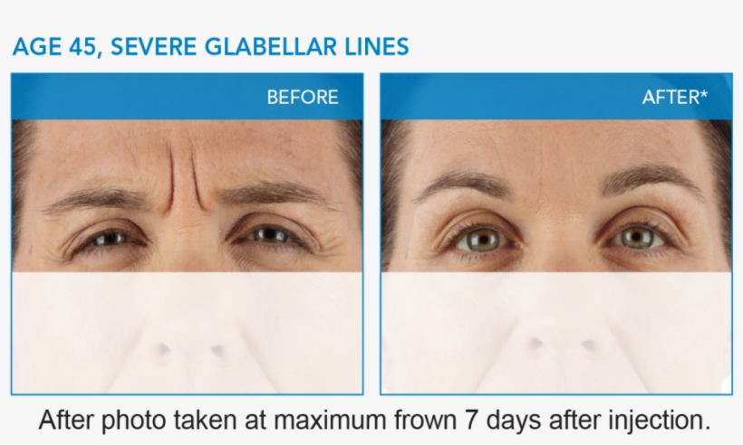 Xeomin® Results - 45u Dysport In Glabella, transparent png download