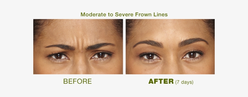 Botox Is An Advanced Skin Treatment That Is Extremely - Botox Areas Before And After, transparent png download