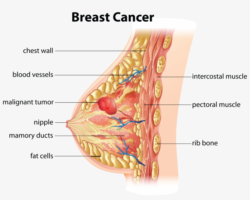 Breast Cancer Pic Clipart - Breast Cancer, transparent png download