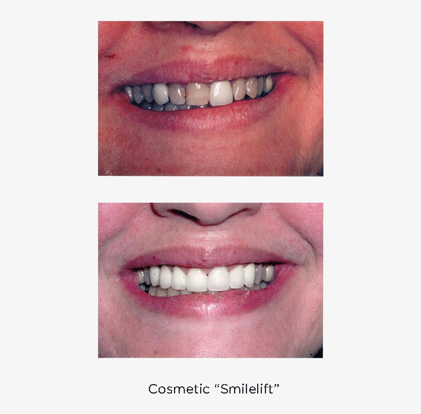 Porcelain Veneers - Cosmetic Dentistry, transparent png download