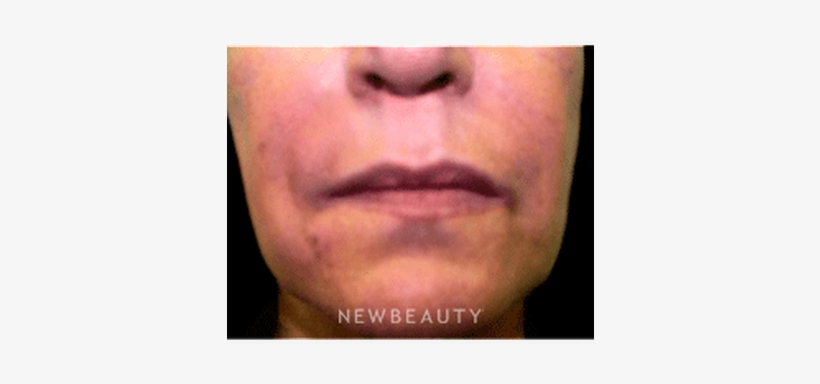 Dr Marina Peredo Radiesse B - Close-up, transparent png download