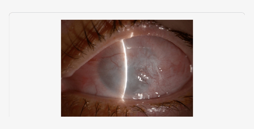 Third Degree Alkali Chemical Burn Os , 24 Months After - Chemical Burn, transparent png download