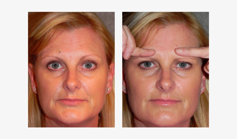 When The Brows - Botox Brow, transparent png download