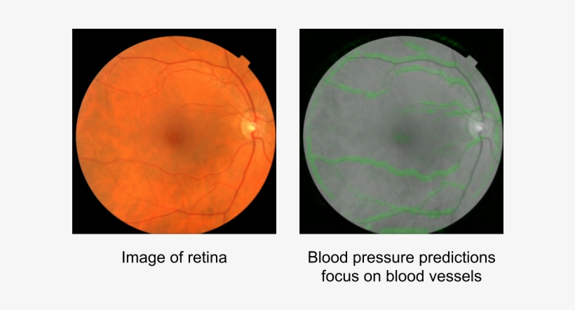 Image Of The Back Of The Eye Showing The Macula , Optic - Retinal Signs Heart Disease, transparent png download