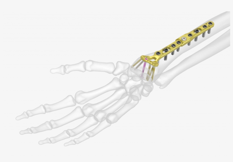 Acu Loc 2 Wrist Plating System - Wrist, transparent png download