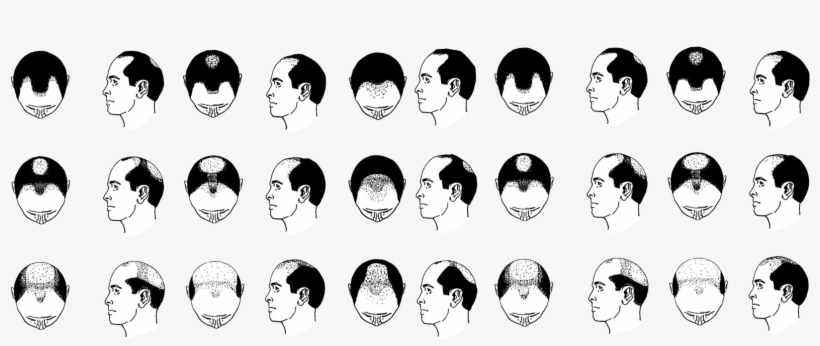 Baldheader1600 - Hair Loss Pattern, transparent png download