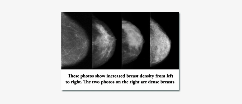 The Problem With High Density Breasts Is That Tumors - Dense Breast Mammogram, transparent png download