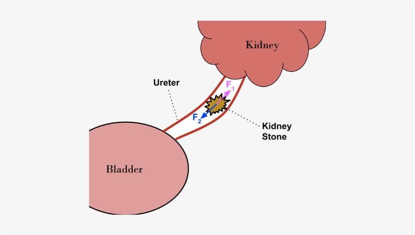Kidney Stone, transparent png download