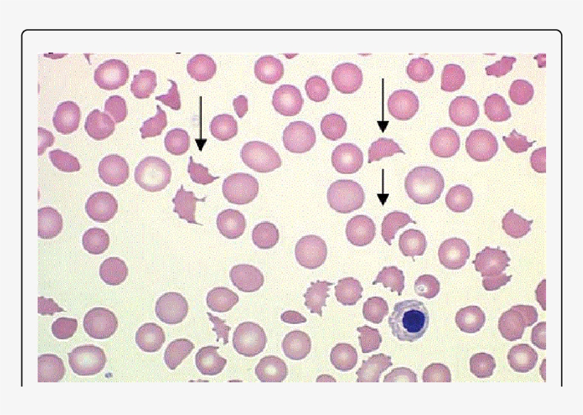 Download Peripheral Blood Smear Of A Patient With Microangiopathic