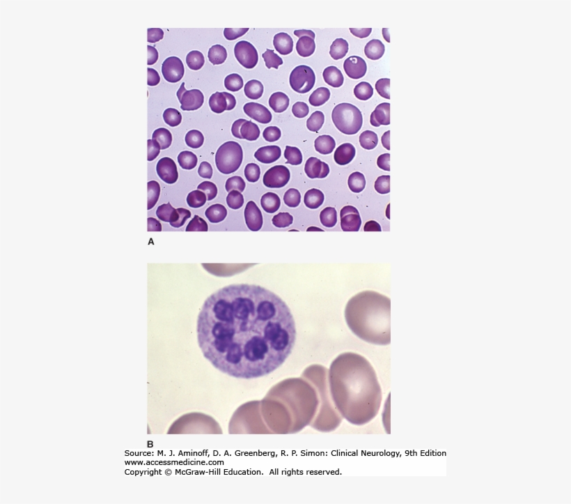 Image Not Available - Pernicious Anemia Cytology, transparent png download