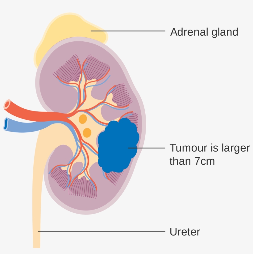 Open - Kidney Cancer Diagram, transparent png download