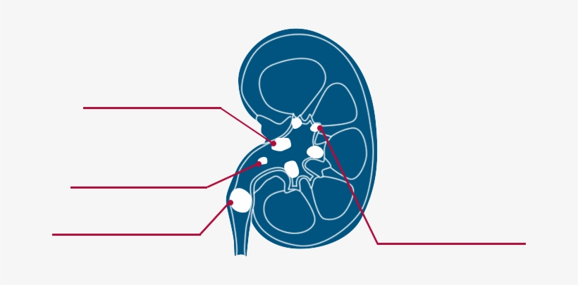Types Of Kidney Stones - Graphic Design, transparent png download