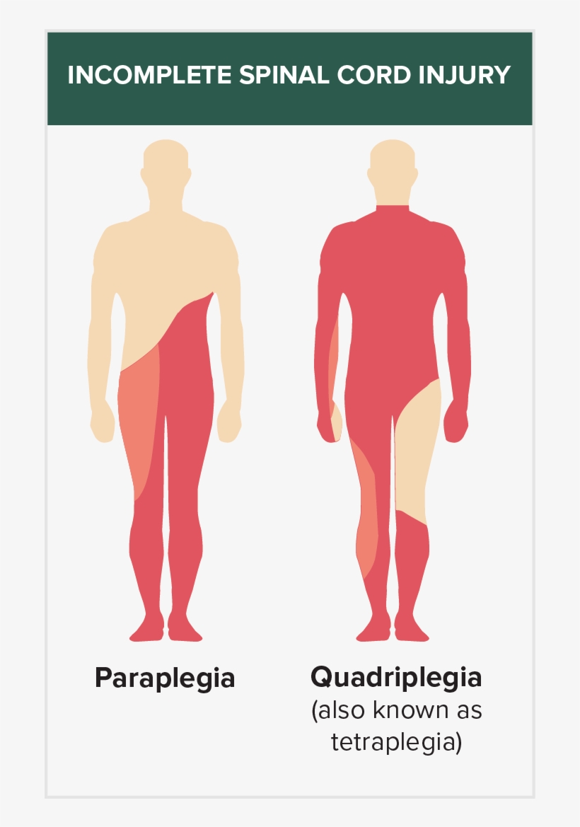 Incomplete Spinal Injury - Incomplete Spinal Cord Injuries, transparent png download