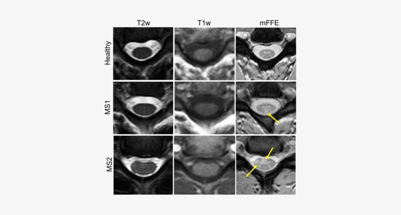 How To Optimise Spinal Cord Mr Acquisitions - Computed Tomography, transparent png download