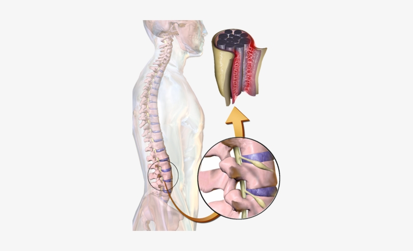 The Outer Tougher Layer Is Known As Dura Mater, The - Spinal Arachnoiditis, transparent png download