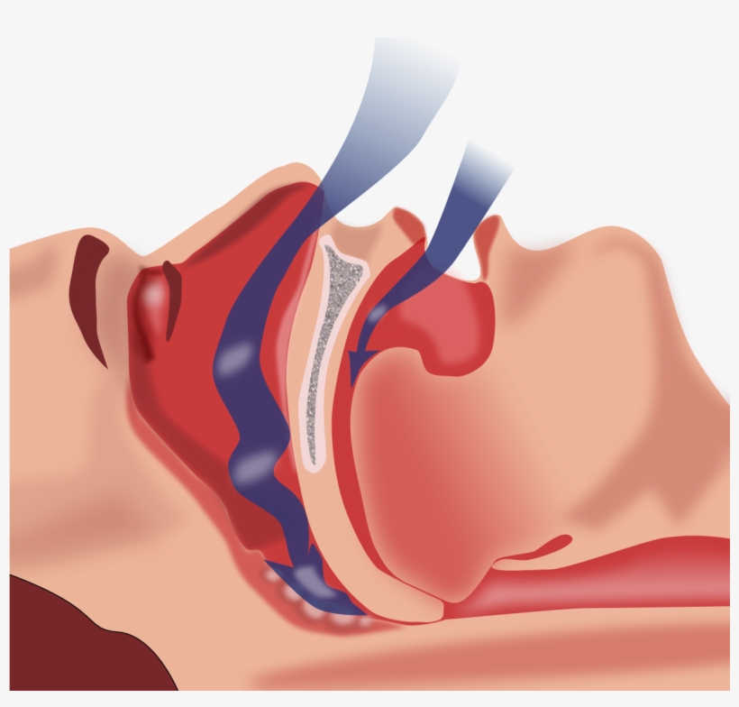 Cpap Treatment For Obstructive Sleep Apnea, transparent png download
