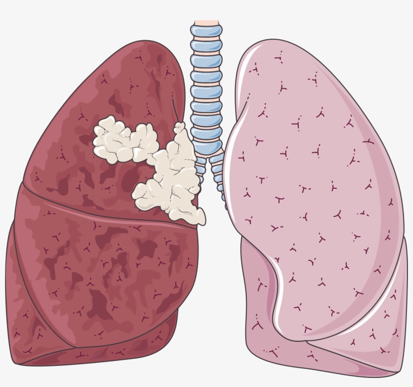 Clipart Library Clipart Lungs - Milo Yiannopoulos Twitter Roasts, transparent png download