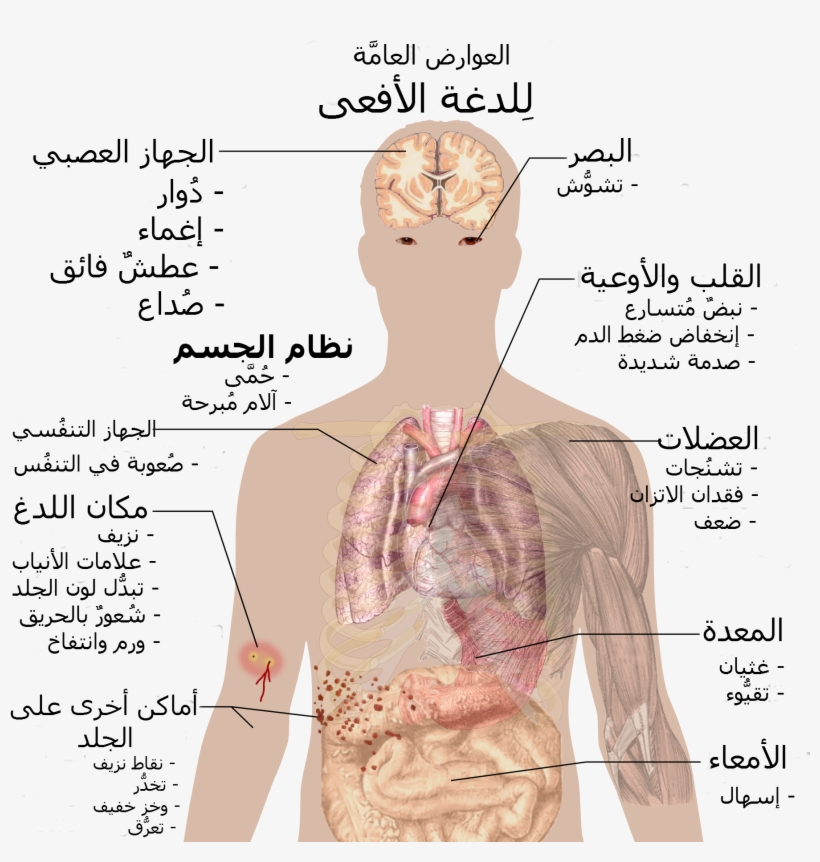 Snake Bite Symptoms-ar - King Cobra Bite, transparent png download